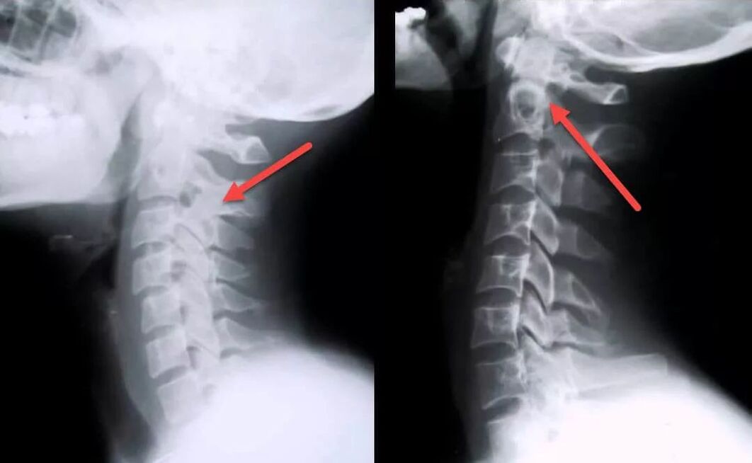 dijagnoza cervikalne osteohondroze