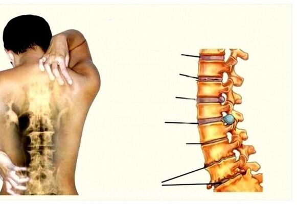 Faze cervikalne osteohondroze