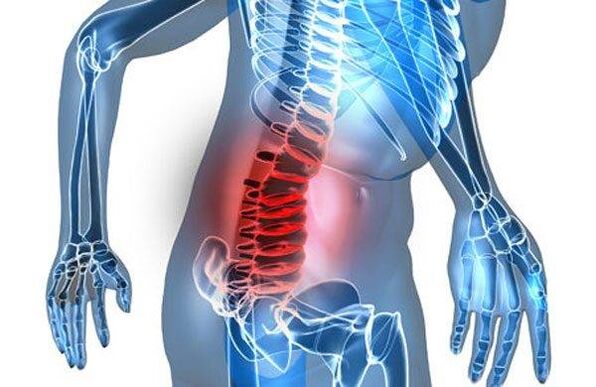 Deformacija kralježnice u četvrtoj fazi lumbalne osteohondroze