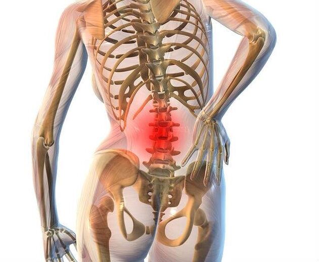 Osteokondroza lumbalne kralježnice