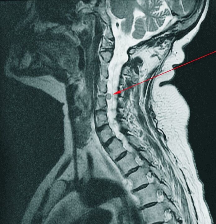 Intervertebralna kila vratne kralježnice na MRI