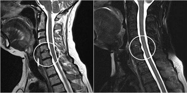 MRI vratne kralježnice sa znakovima osteohondroze